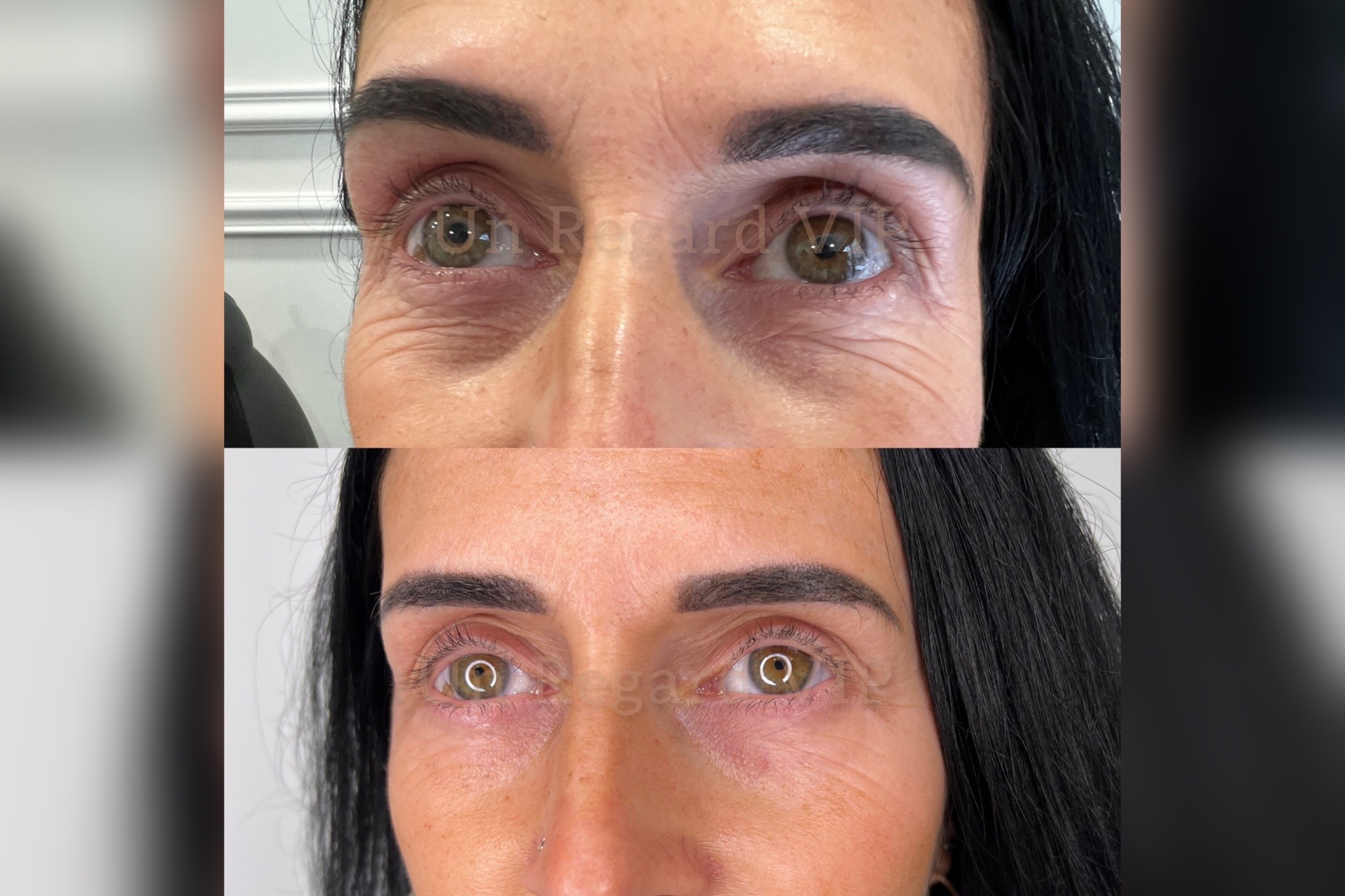 Plasma Lift-Un Regard VIP-1