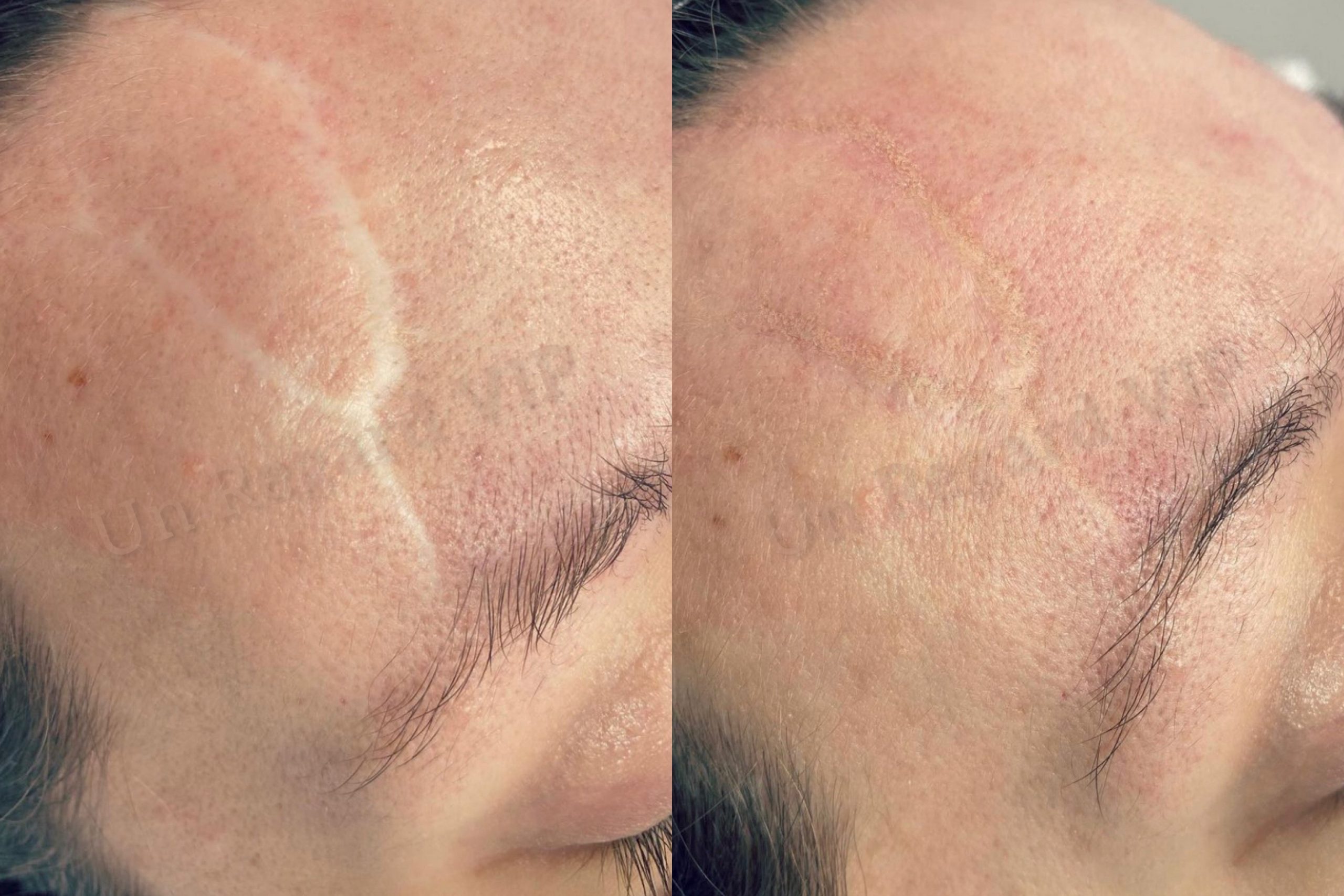 Plasma Lift-Un Regard VIP-4