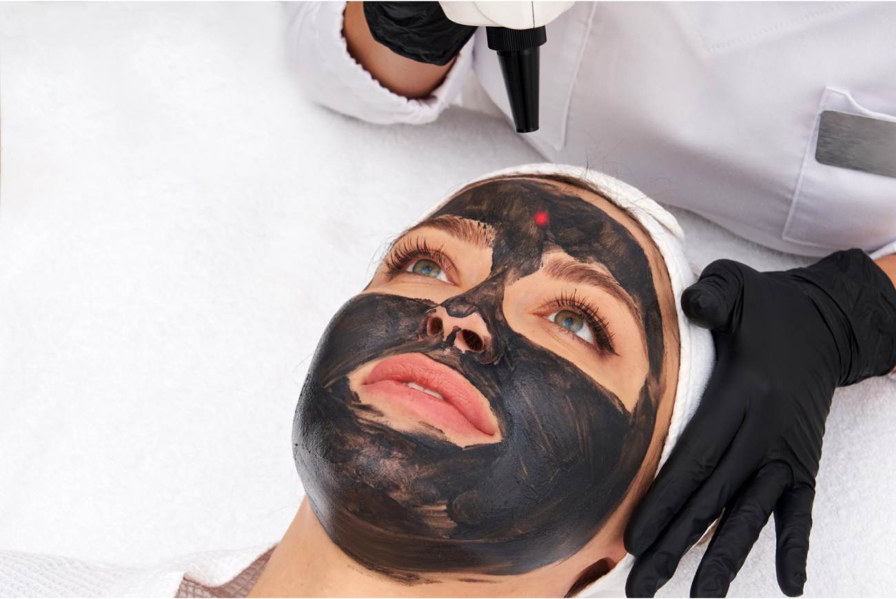 Carbon Peel