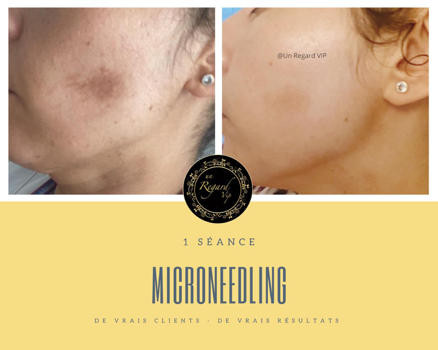 Le microneedling
